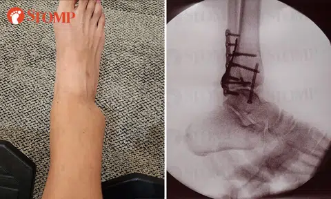 Woman suffers broken ankle after going down slide at indoor inflatable playground in Jurong East