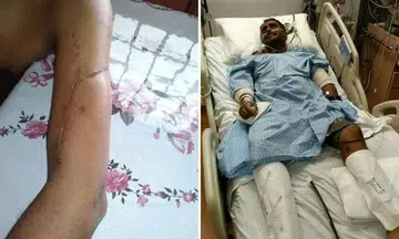 Mr Patrick Pereira had to undergo a nerve graft to repair a contused nerve in his left arm after he was involved in a collision with a lorry in 2017