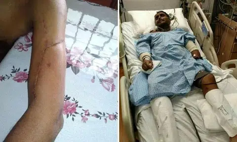 Mr Patrick Pereira had to undergo a nerve graft to repair a contused nerve in his left arm after he was involved in a collision with a lorry in 2017