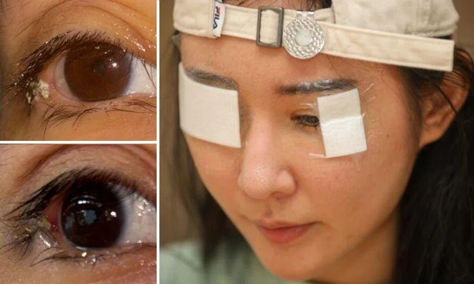 The woman was suffering from formaldehyde poisoning, which was diagnosed only after she was referred to an ophthalmologist. Photos: The Straits Times