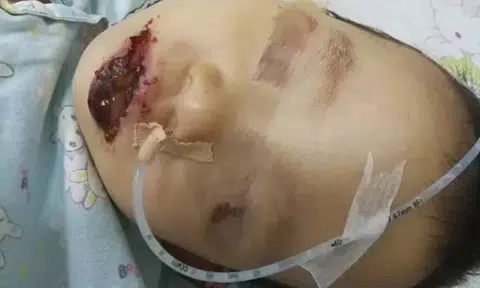 Toddler in China suffers severe burns to lips and mouth after mistaking washing powder for milk powder