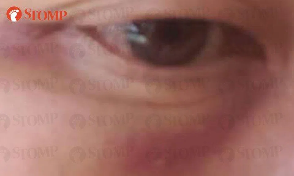 Injuries bore by Loh after the assault.