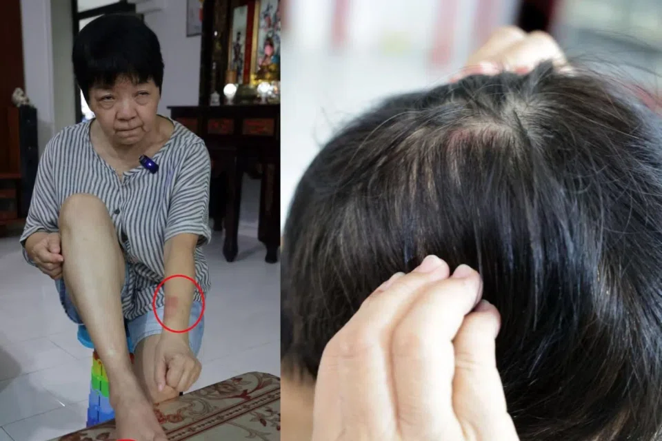 Madam Zhuo Jinfeng claims she was injured in her fight with her younger brother.