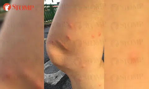 SIA responds to passenger's claim about getting bitten by bed bugs in business class from Brisbane to S'pore