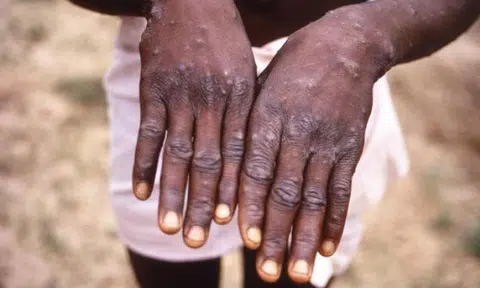 MOH confirms first case of monkeypox in Singapore