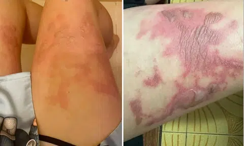 Admiralty foodcourt staff spilled hot soup on woman's legs: 'I keep getting new blisters'