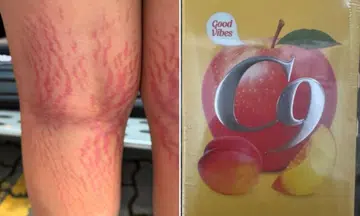 Boy, 12, gains 6kg, develops stretch marks after using ‘herbal’ eczema cream found on Facebook