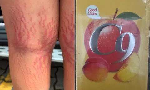 Boy, 12, gains 6kg, develops stretch marks after using ‘herbal’ eczema cream found on Facebook