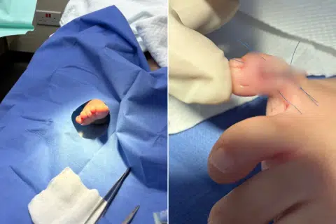 Chinese tourist's daughter cuts toe while playing at beach club during holiday