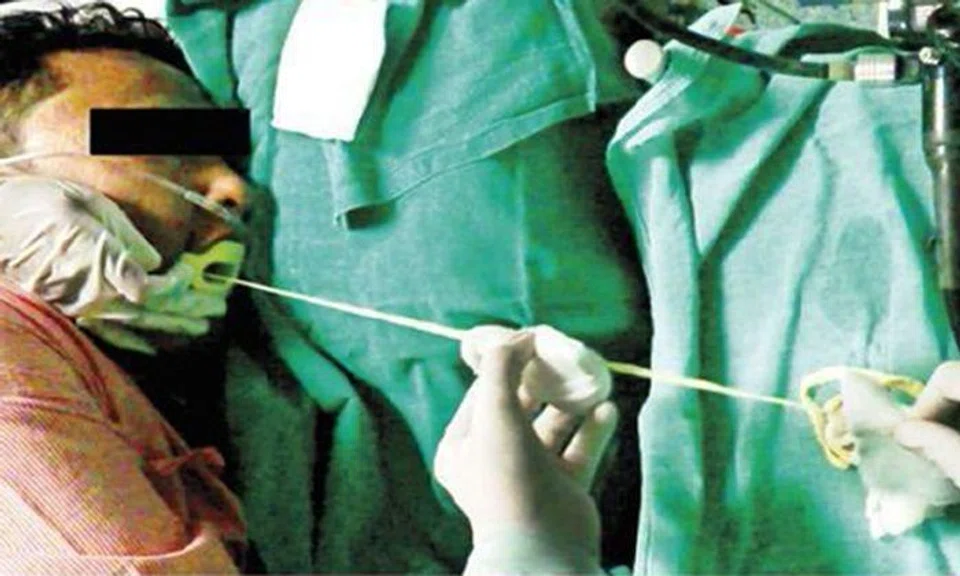 Doctors pull out 1.88m tapeworm from man's intestine in India