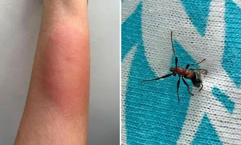 Man's arm swells after getting bitten by 'most poisonous' ant in Toa Payoh