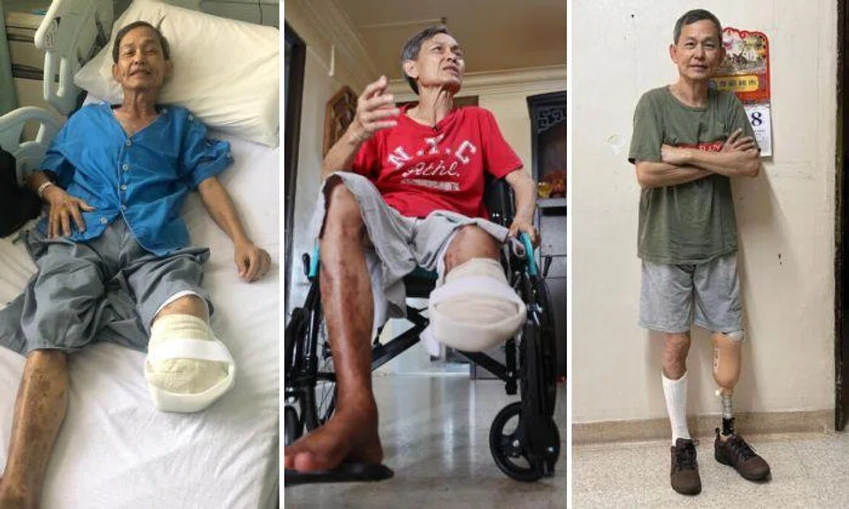 Duan Weiming, who had his left leg amputated below the knee in September due to diabetes, is learning to walk again. Photos: Lianhe Zaobao, Shin Min Daily News