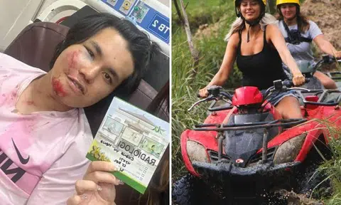 A Singaporean student on holiday fractured his left cheekbone and suffered memory loss after the all-terrain vehicle (ATV) he was riding crashed into a coconut tree in Ubud, Bali.