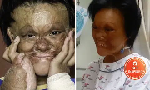 Girl left severely disfigured by fire -- can now smile again
