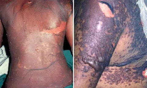 Between February 2024 and February 2025, seven men and two women were hospitalised after consuming these medicines. PHOTO: NATIONAL SKIN CENTRE