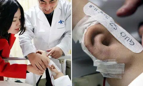 Chinese man grows new ear on arm for transplant