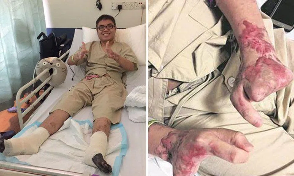 Kind-hearted netizens raise over $40k for 22-year-old who lost fingers and legs to gangrene