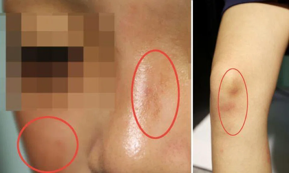 The girl told ST that she had a nose bleed, swollen lips and bruises on her legs. Photos: Shin Min Daily News