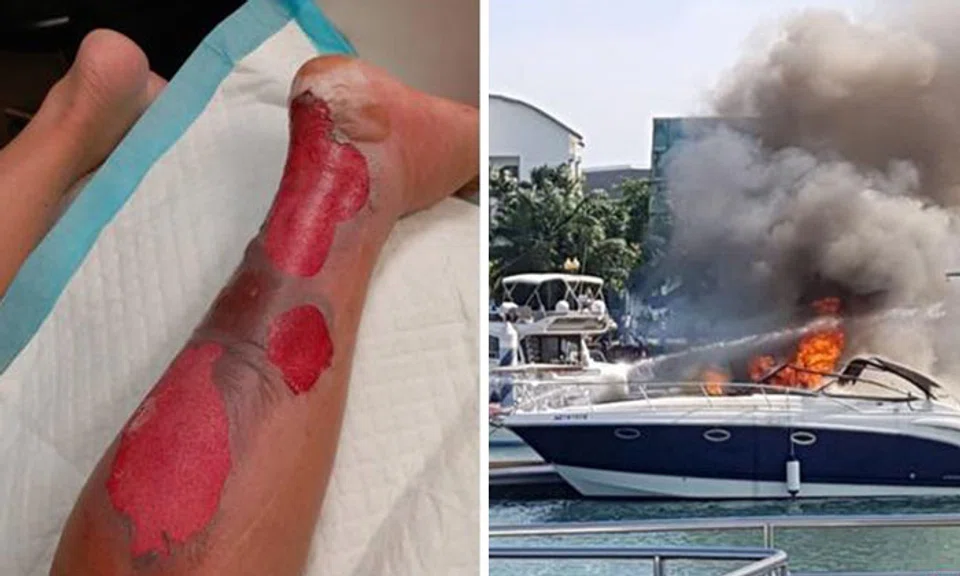 Mr Tu suffered second-degree burns on his left ankle (left) during the yacht fire (right)