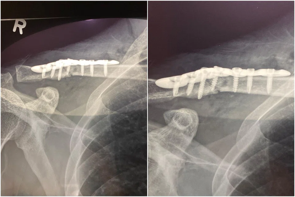Mr Lee sustained a collarbone fracture after the front tyre of his bicycle ran into a sharp metallic object along the same road, causing him to fall off.