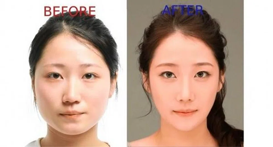 8 most popular plastic surgery procedures in South Korea