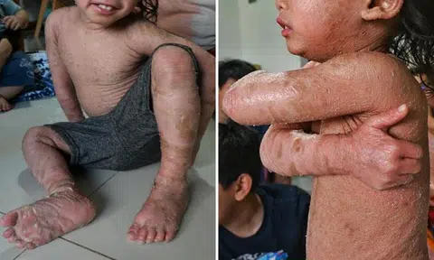 Rafif Akari Abdul Hadi has been suffering from a rare skin disease, congenital ichthyosis, since birth. PHOTOS: BERITA MINGGU