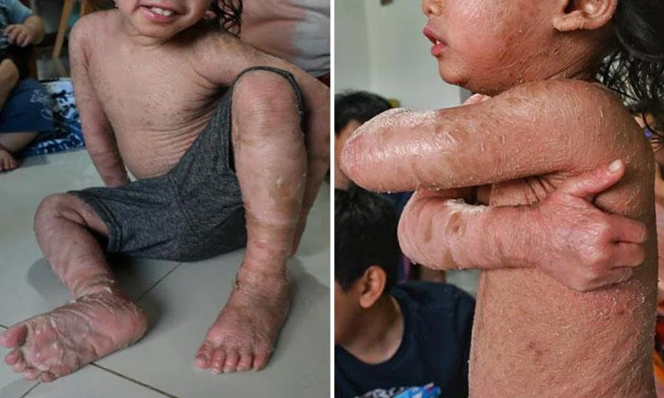 Rafif Akari Abdul Hadi has been suffering from a rare skin disease, congenital ichthyosis, since birth. PHOTOS: BERITA MINGGU