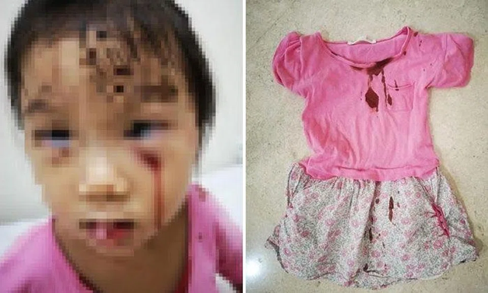 The girl suffered several cuts to her face and had to be put under general anaesthesia in order for the wound to be stitched up. PHOTOS: SHIN MIN DAILY NEWS