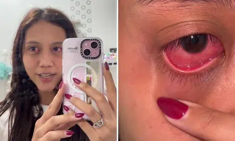 Woman learns painful lesson after buying $8 contact lenses from shop on TikTok