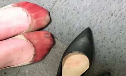 Waitress shows how damaging heels can be after being made to wear a pair