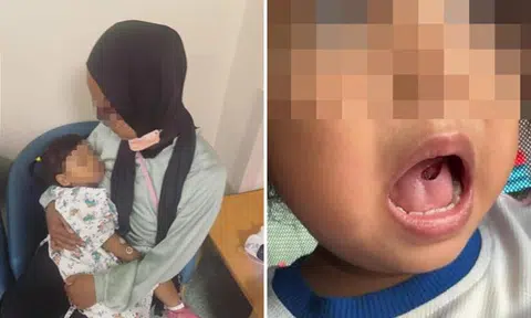 Toddler gets 12 stitches on tongue after fall, mum says preschool downplayed injury 'that turned out be very serious'