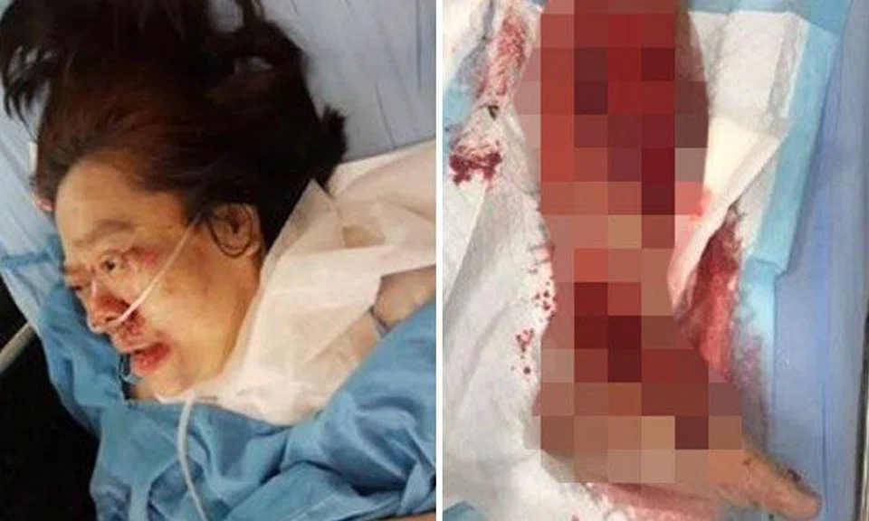 Skin on woman’s leg ripped off after lorry hits and drags her along Woodlands junction