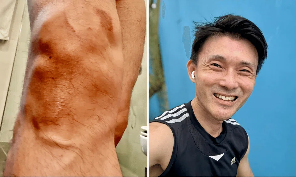 "Fortunately I just had light abrasions. My phone had it worse," said Mr Baey.