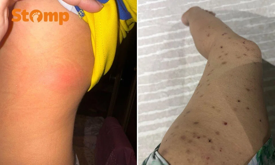 mosquito bite on arm and leg