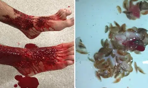 Aussie teen's legs become bloody mess after getting attacked by sea lice