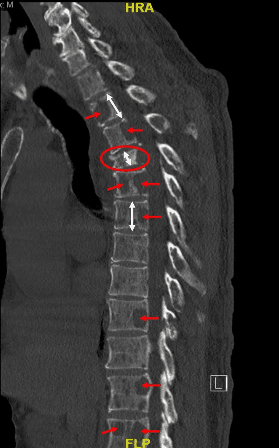 While showing a radiology photo to Judge Lee, SC Bull said the cancer had hollowed out his spinal vertebrae.