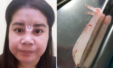 Botched surgery leaves Thai woman with additional hole in her nose