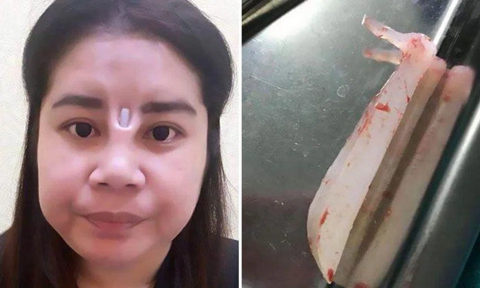Botched surgery leaves Thai woman with additional hole in her nose