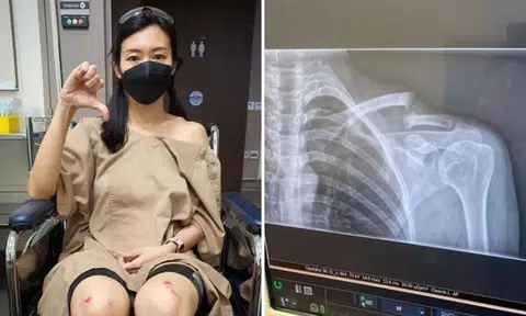 Actress Jaime Teo needs surgery after breaking collarbone in cycling accident