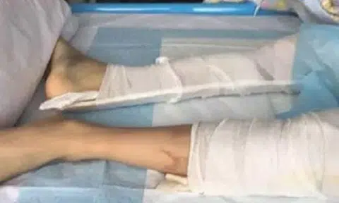 Chinese teen breaks both legs after falling off 4th storey, asks to play game upon waking in hospital