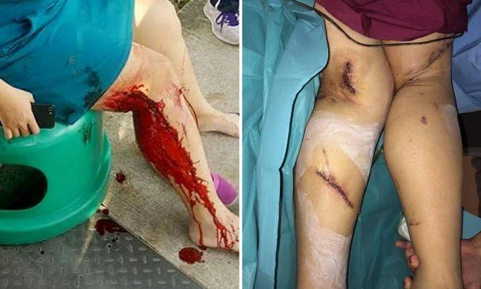 Madam Alice Ng's legs still bear the scars (right) of the 2018 attack (left). Her injuries were so serious she had to undergo three operations to seal up her wounds. Photos: Alice Ng, Facebook