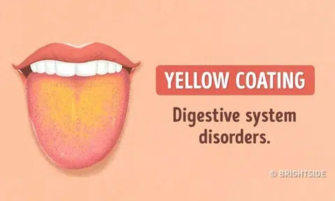 Here's what the colour of your tongue suggests about your health