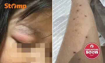 mosquito bite on eyelids, scars