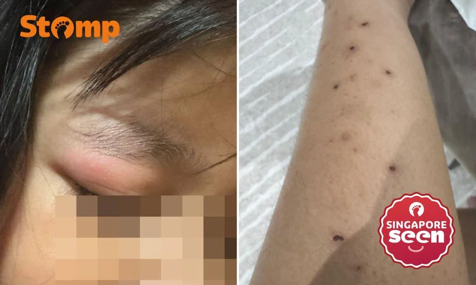 mosquito bite on eyelids, scars