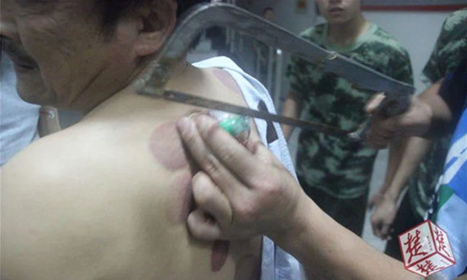 Firemen saw off cup from Wuhan man's back after DIY treatment goes wrong