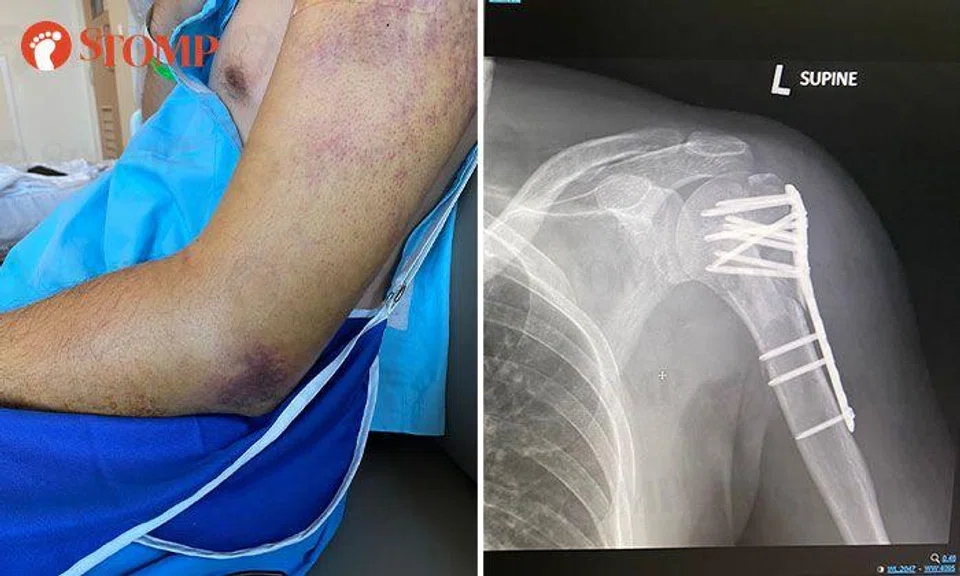 Another injury at Bouncy Paradise: Man breaks arm after jumping onto inflatable mat