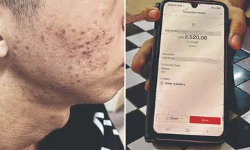 Mum says NSF son, 20, pressured to spend $3.3k to cure acne