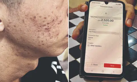 Mum says NSF son, 20, pressured to spend $3.3k to cure acne