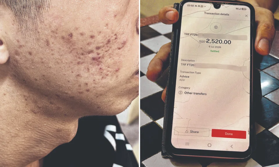 Mum says NSF son, 20, pressured to spend $3.3k to cure acne