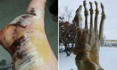 US cancer survivor's amputated foot get its own Instagram account -- and becomes One Foot Wander